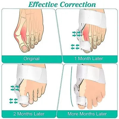 FLEXIBLE ORTHOPAEDIC BUNION CORRECTOR